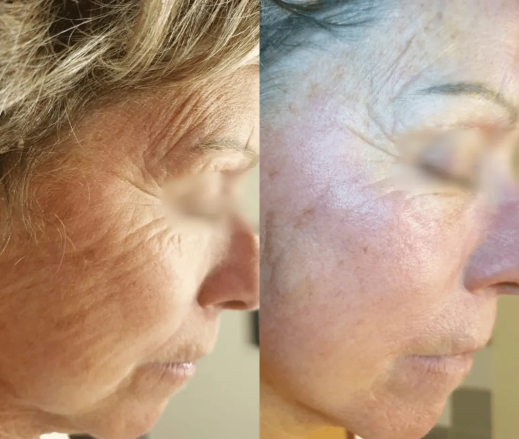 Antes y después de arrugas y líneas de expresión con Porcelaine