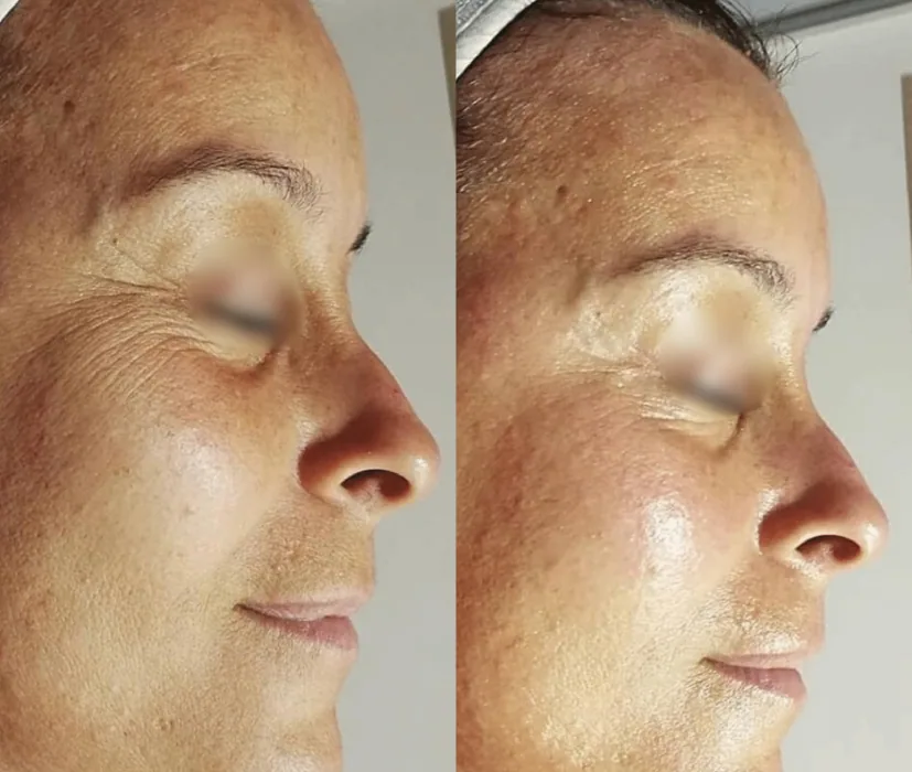 Antes y después de luminosidad con Porcelaine