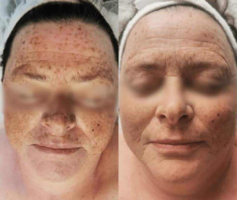 Antes y después de manchas con Porcelaine