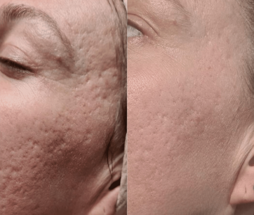 Porcelaine el «Efecto borrador» de Bloomea